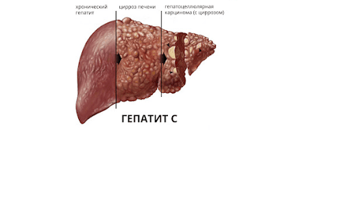 Печінка вражена гепатитом